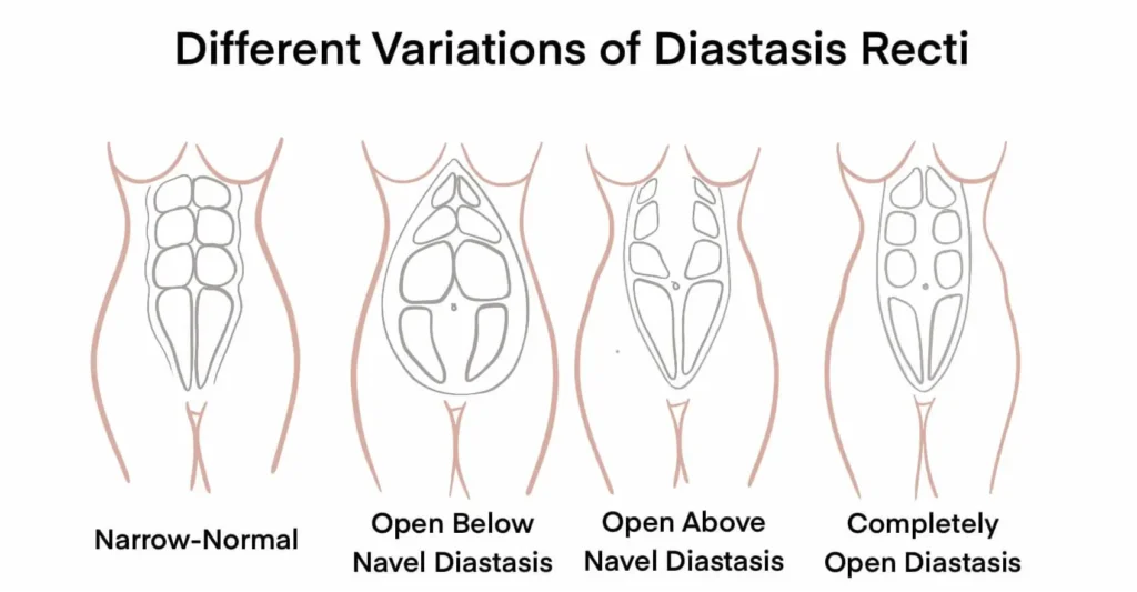 Diastasis